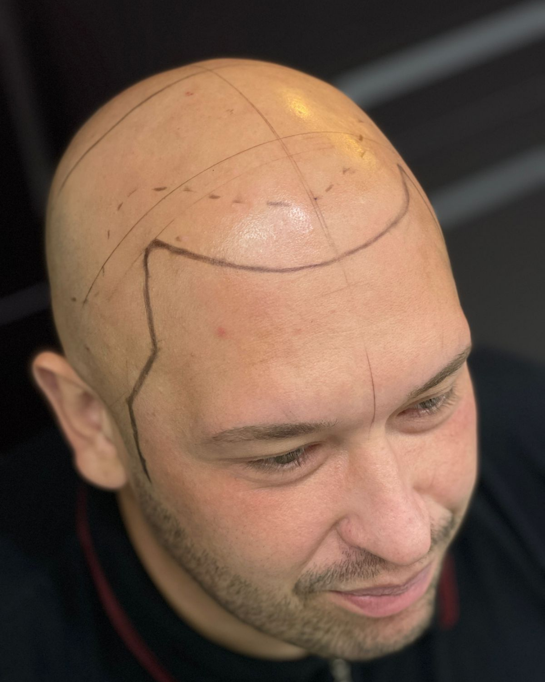 Diseño personalizado de línea frontal — Rafael Scalp Artist
